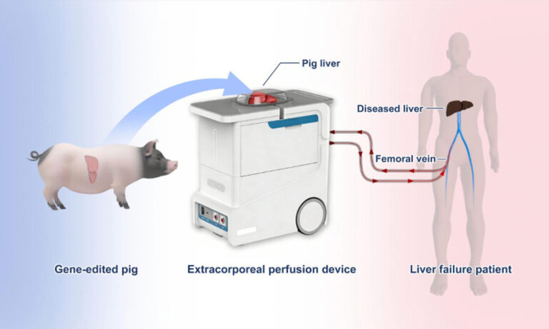 Des scientifiques chinois réalisent le premier traitement au monde d'un patient atteint d'insuffisance hépatique en utilisant une perfusion ex vivo avec un foie de porc modifié génétiquement (rapport)