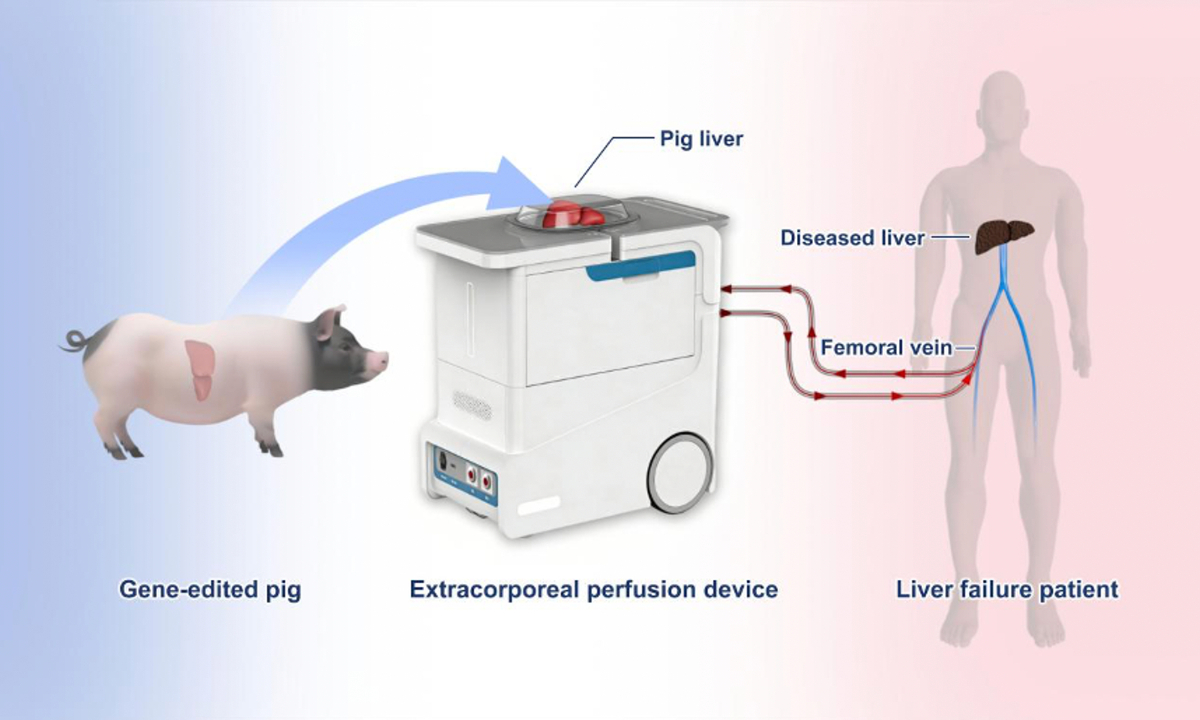 Illustration of the treatment of a liver failure patient using ex vivo perfusion with a six-gene-edited pig liver Photo: Courtesy of Xijing Hospital